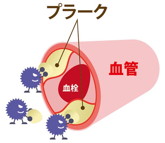 動脈硬化イメージ